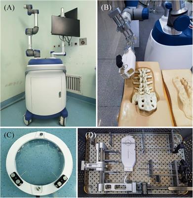 Advantages of robot-assisted PKP under local anesthesia in the treatment of OVCF: a retrospective, non-randomized, controlled, clinical study